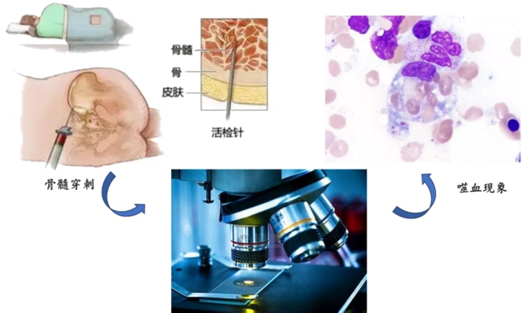 生命警报：噬血细胞综合征到底有多凶险？