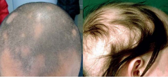 这4个无意间的行为，正在加重你的脱发！第3个很多人都中招了