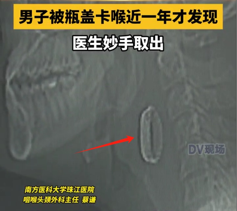 男子喉咙卡啤酒盖近一年竟浑然不知？医生紧急提醒