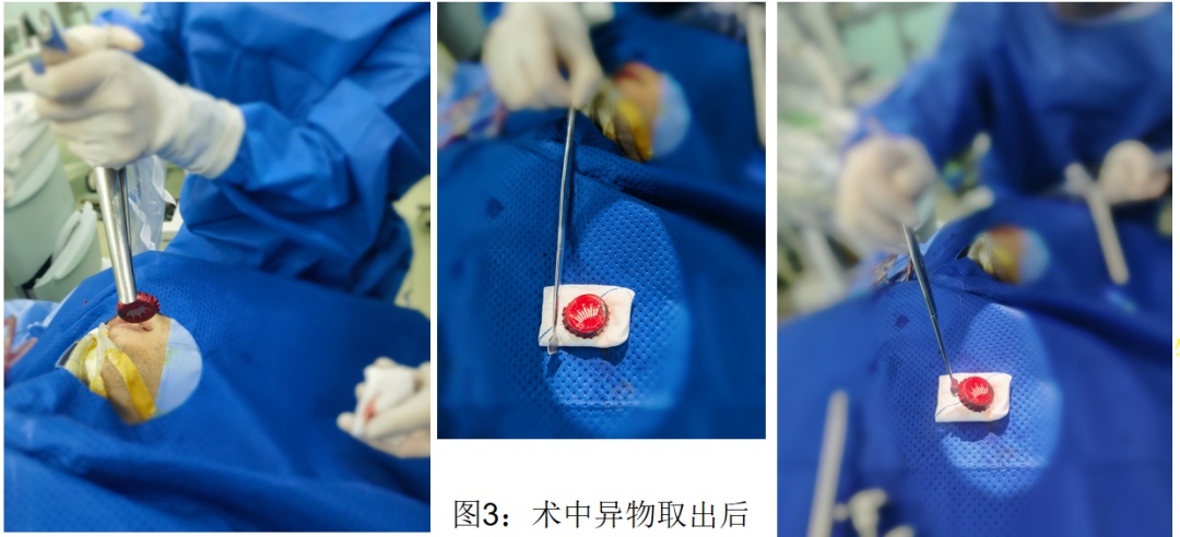 男子喉咙卡啤酒盖近一年竟浑然不知？医生紧急提醒