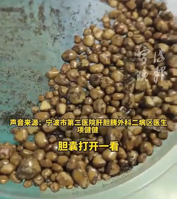 26岁女子胆囊长出上百颗结石！这个习惯危害竟有这么大