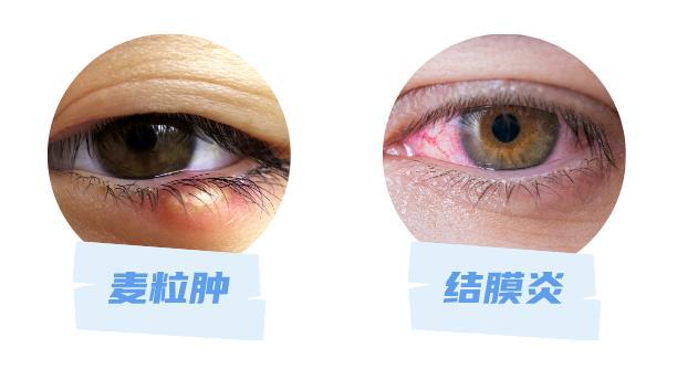 医生,揉眼睛居然有可能进ICU? 医生,揉眼睛居然有可能进ICU?