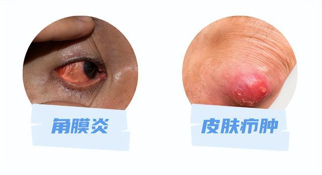 医生,揉眼睛居然有可能进ICU? 医生,揉眼睛居然有可能进ICU?