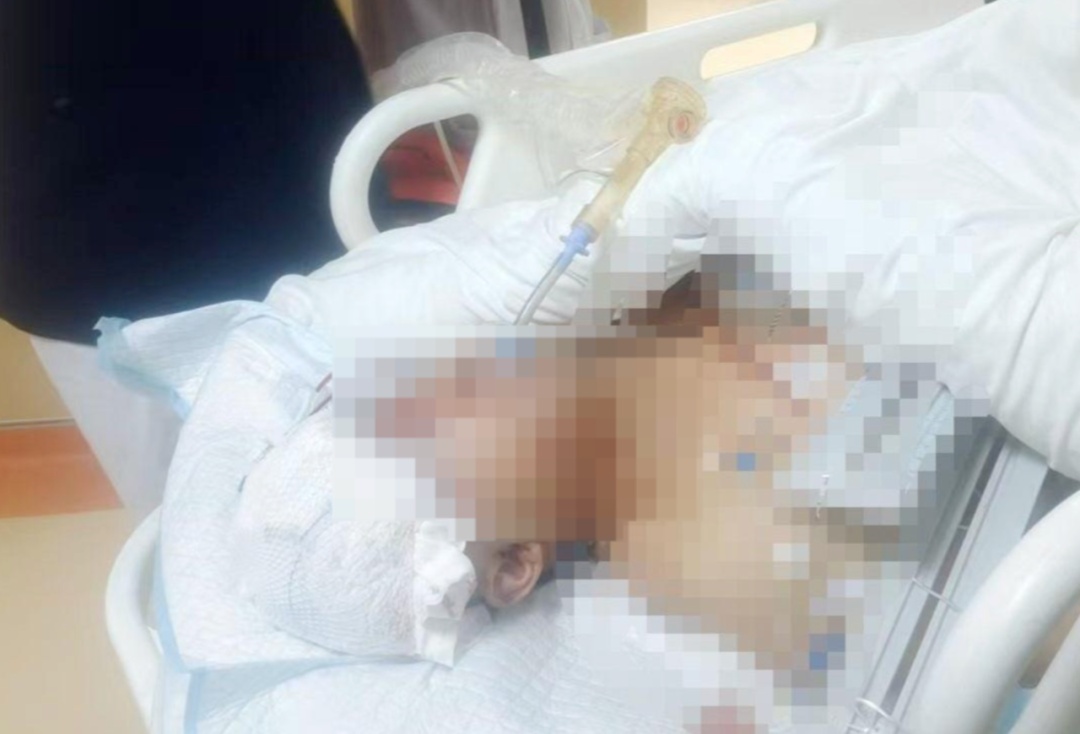 贵州一男子多处动脉被野猪咬断 贵州一男子多处动脉被野猪咬断