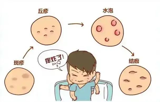 水痘进入高发季 家长该怎么做~