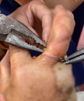 一份煎年糕，让女子右手爬满水泡，状如鸽子蛋！