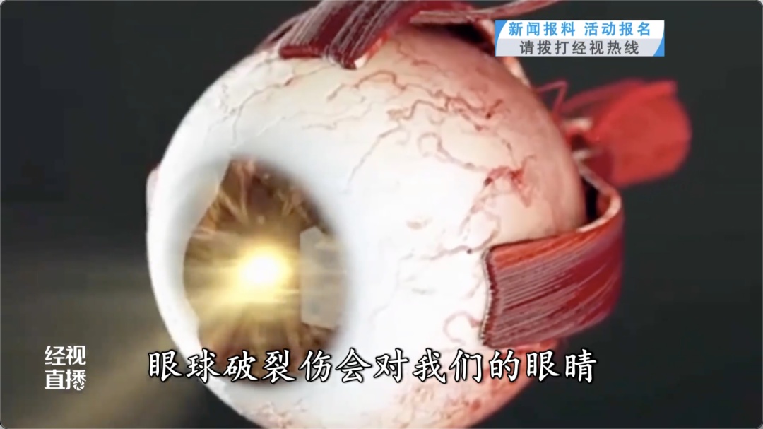 女子眼球被刺穿!医生提醒 女子眼球被刺穿!医生提醒