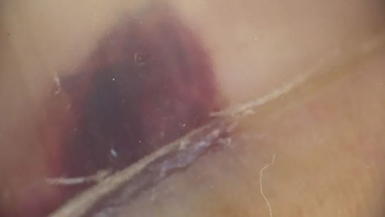 指甲出现黑线、竖纹是病吗？3种易被忽视的甲疾患，小心这种会癌变！