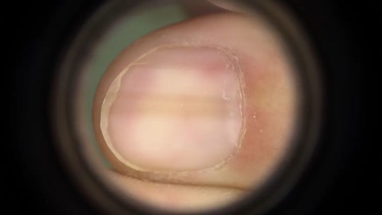 指甲出现黑线、竖纹是病吗？3种易被忽视的甲疾患，小心这种会癌变！