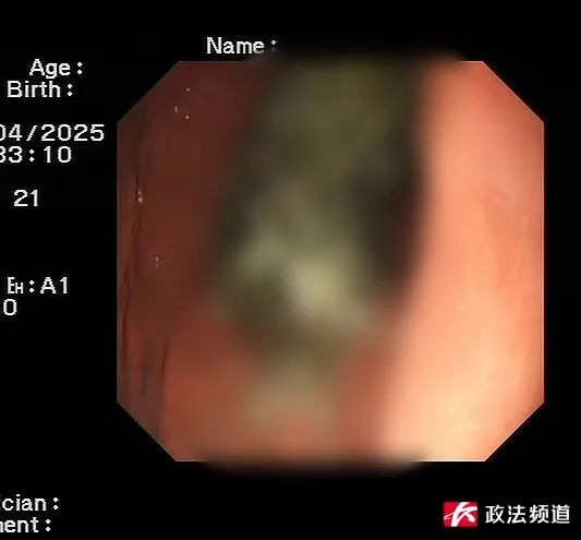 长沙8岁女孩经常腹痛,医生一看震惊了:胃里密密麻麻都是它 长沙8岁女孩经常腹痛,医生一看震惊了:胃里密密麻麻都是它