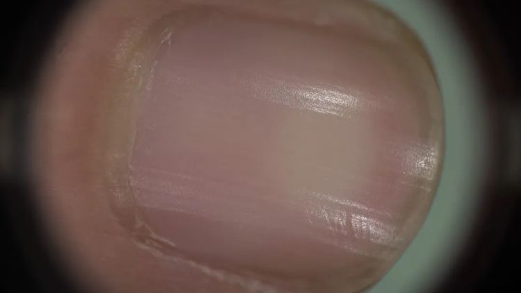 指甲出现黑线、竖纹是病吗？3种易被忽视的甲疾患，小心这种会癌变！
