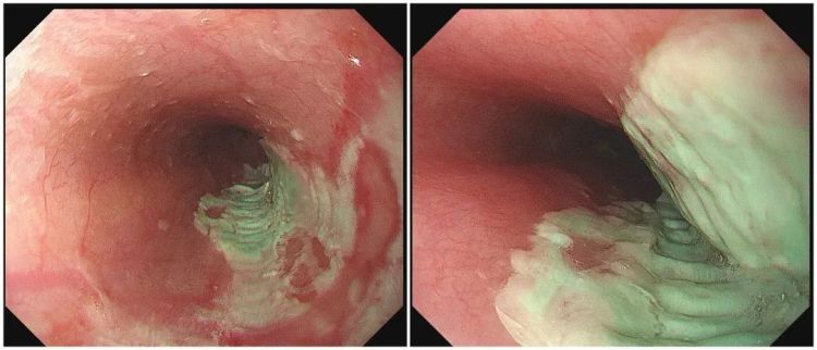 男子食道长满“刀口”，只因一个错误习惯