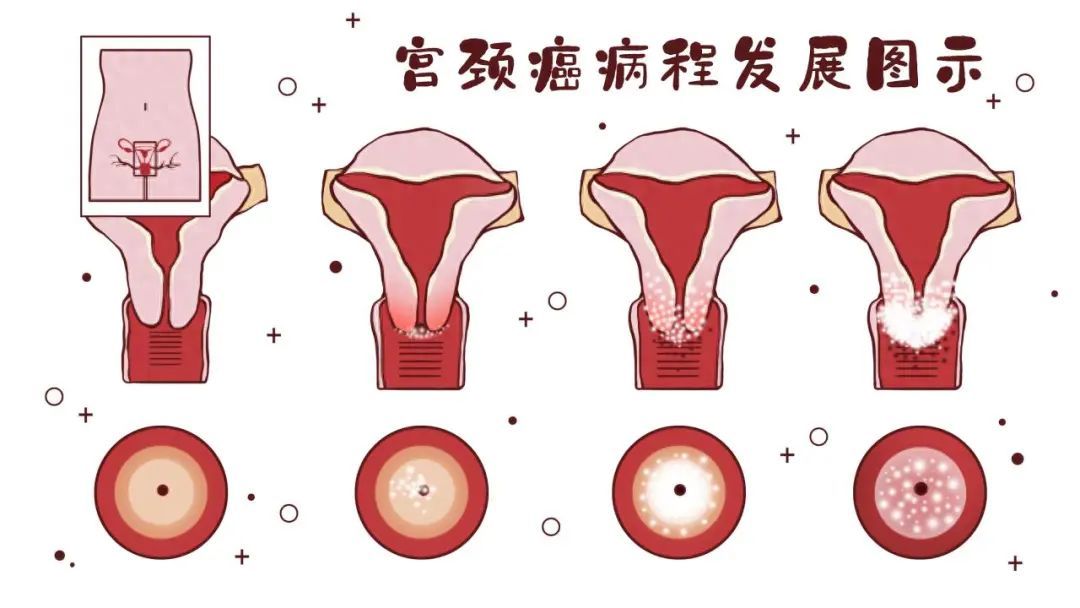 母女同行、愿接尽接！北京延伸HPV疫苗接种范围