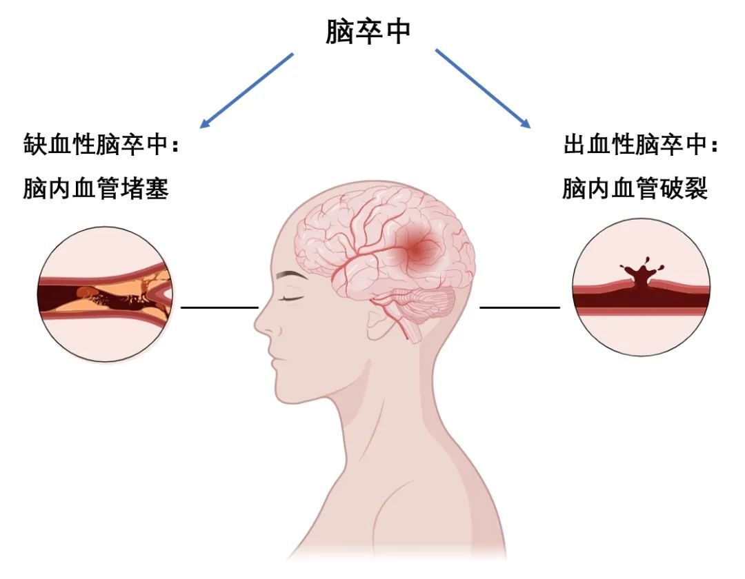 16岁高中生突然像变了个人:成绩下降,反应迟钝!医生:中风了 16岁高中生突然像变了个人:成绩下降,反应迟钝!医生:中风了
