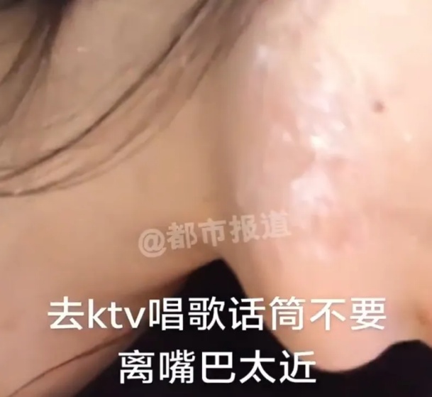 女子唱K离话筒太近被病毒“缠上”，无药可治！专家提醒→