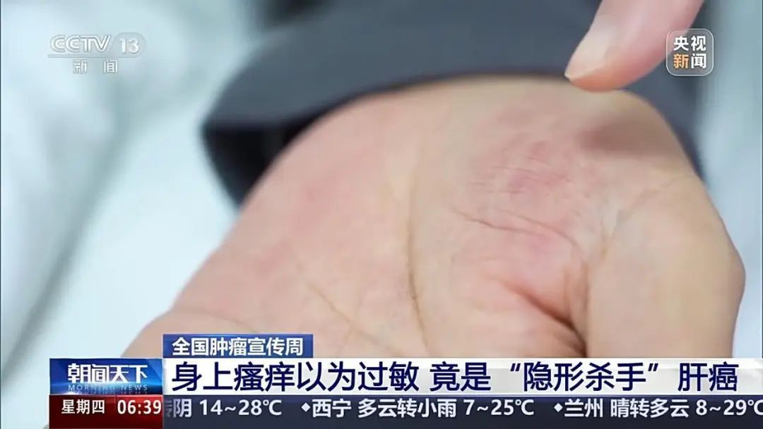 男子皮肤瘙痒不止一查竟是肝癌！医生紧急提醒