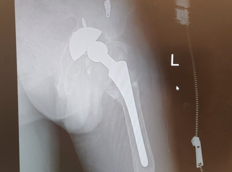 拔牙进了ICU，男子险没命！医生紧急提醒