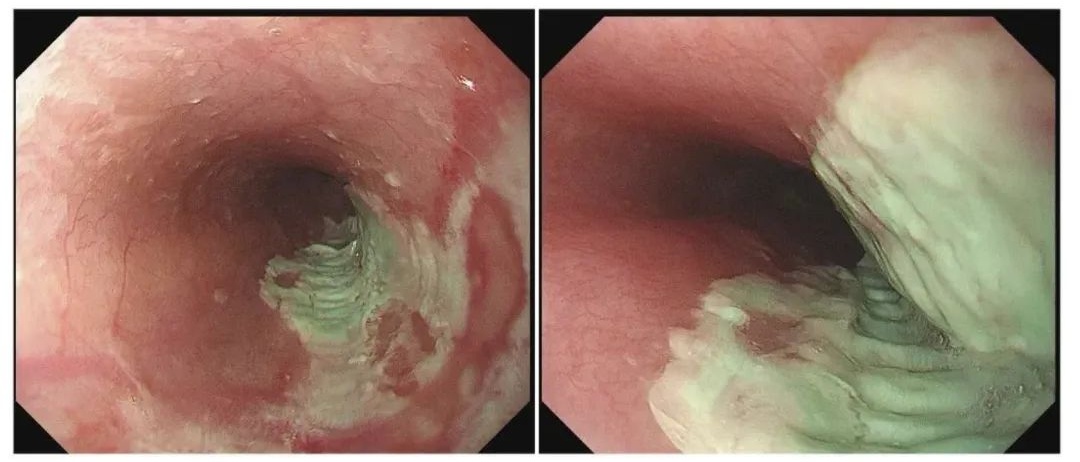 35岁男子食道被"割烂"，只因这个错误习惯！很多人都爱这么干…