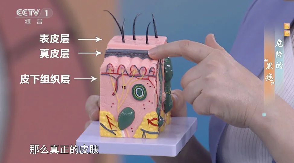 你身上的一颗痣竟可能会癌变？这样自查帮你找出“危险分子”