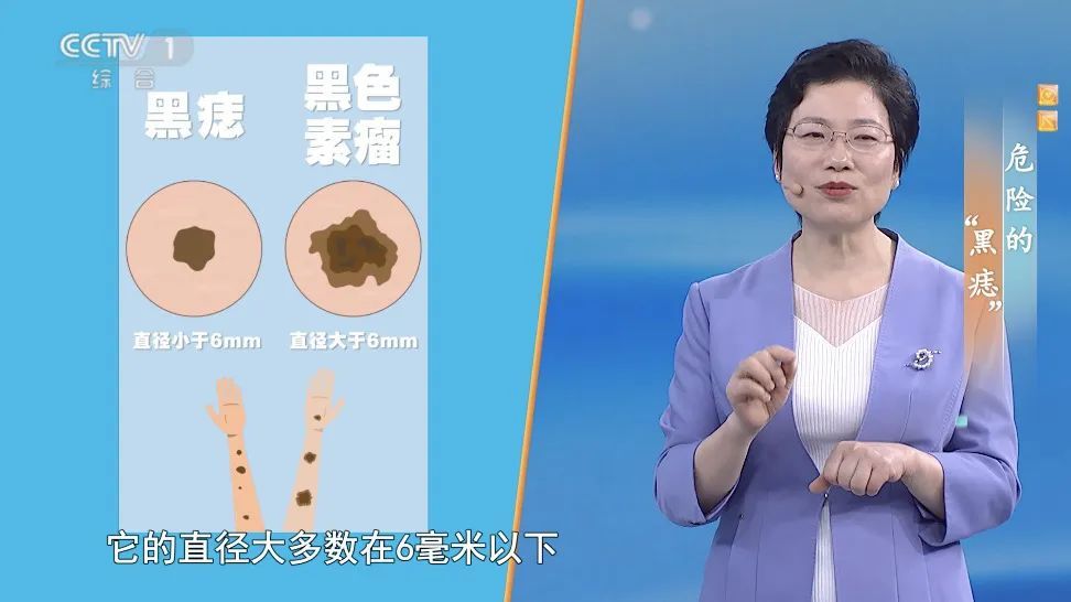 你身上的一颗痣竟可能会癌变？这样自查帮你找出“危险分子”