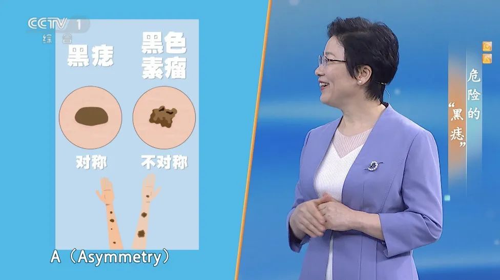 你身上的一颗痣竟可能会癌变？这样自查帮你找出“危险分子”