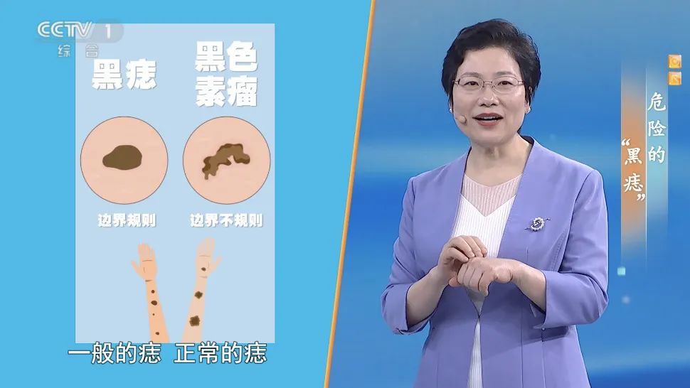 你身上的一颗痣竟可能会癌变？这样自查帮你找出“危险分子”