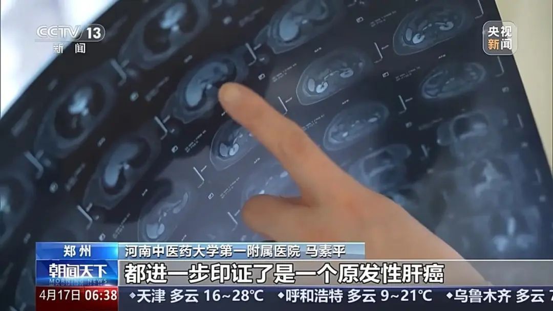 男子皮肤瘙痒不止一查竟是肝癌！医生紧急提醒