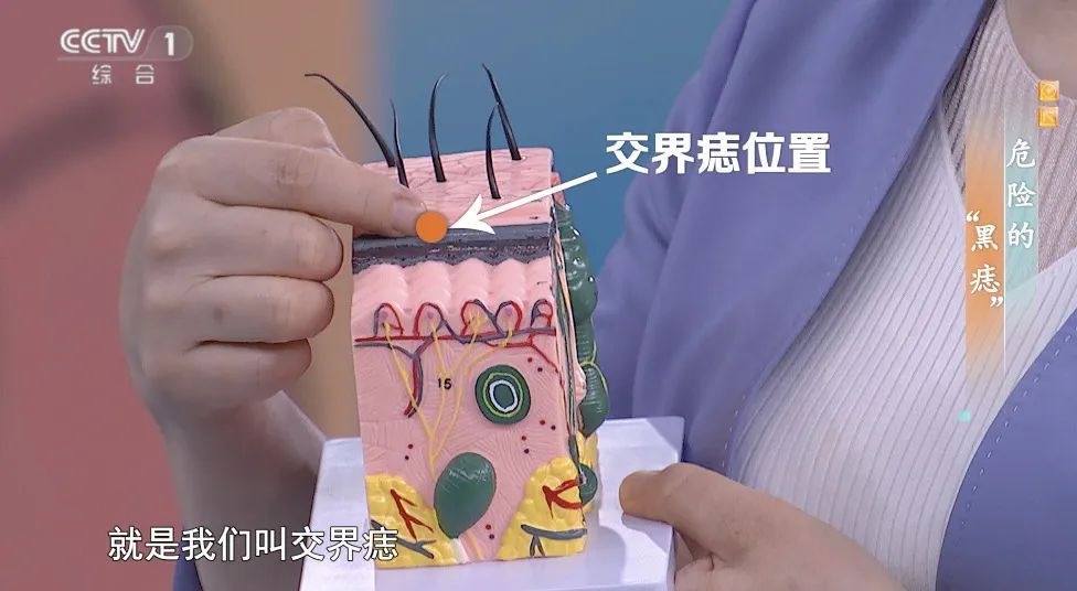 你身上的一颗痣竟可能会癌变？这样自查帮你找出“危险分子”