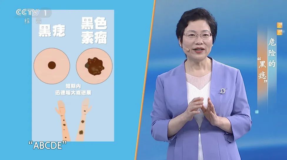 你身上的一颗痣竟可能会癌变？这样自查帮你找出“危险分子”