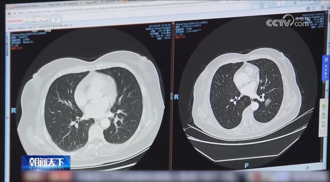 这种癌症早期大多无症状，6个部位也要及时检查
