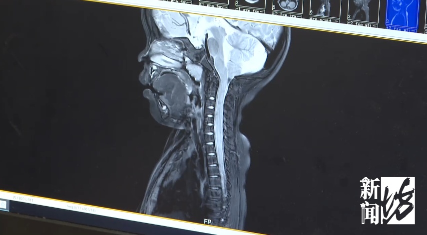 唯一有效药物!上海有人用上了!知名男演员也曾确诊该病 唯一有效药物!上海有人用上了!知名男演员也曾确诊该病