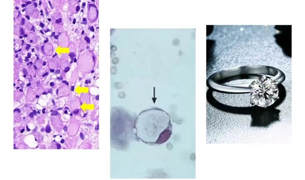 女子呕血3天一查竟患“癌王”！这5种症状要注意