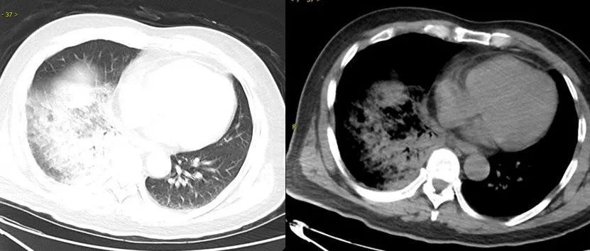 女子双肺全白,抢救12天!医生提醒:早期症状很像感冒,千万别硬扛! 女子双肺全白,抢救12天!医生提醒:早期症状很像感冒,千万别硬扛!