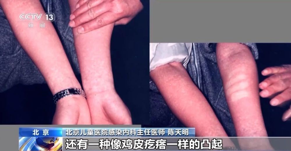 孩子发热、咽痛还伴皮疹，“小红人”到底是种什么病？