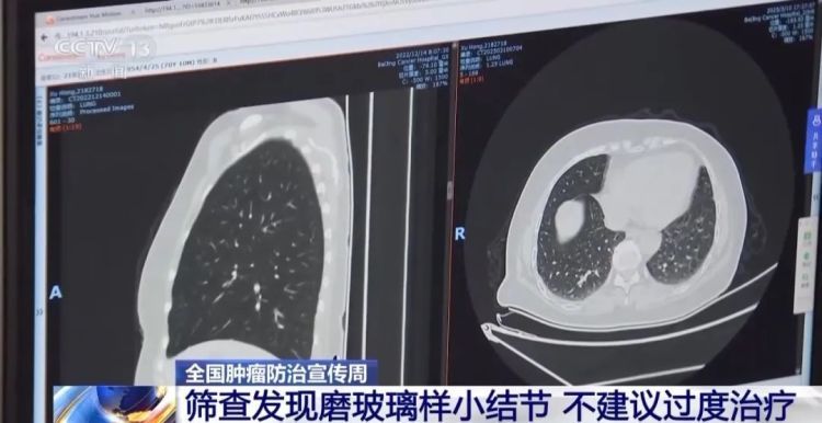 连续10年全球死亡率第一！这种癌症早期通常无症状，专家提醒