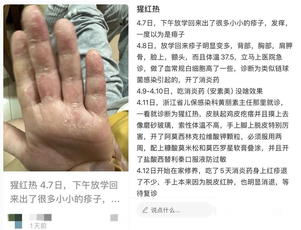 孩子发热、咽痛还伴皮疹，“小红人”到底是种什么病？