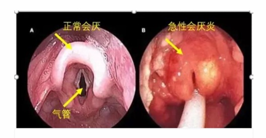 从就诊到去世仅10分钟！这种喉咙痛，别以为是感冒上火