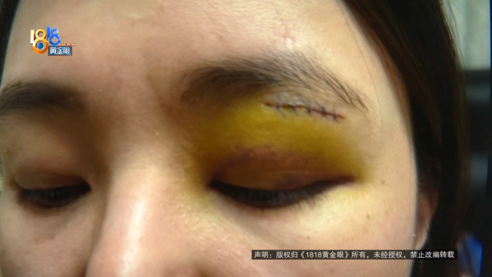 女子餐厅内撞上玻璃,香奈儿眼镜当场报废还缝了好几针,店家仅补偿400元? 女子餐厅内撞上玻璃,香奈儿眼镜当场报废还缝了好几针,店家仅补偿400元?