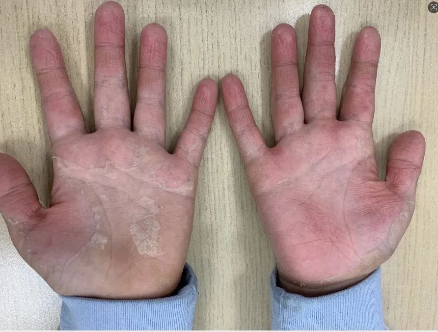 孩子高热不退全身起疹“像鸡皮疙瘩一样”，甚至出现血尿