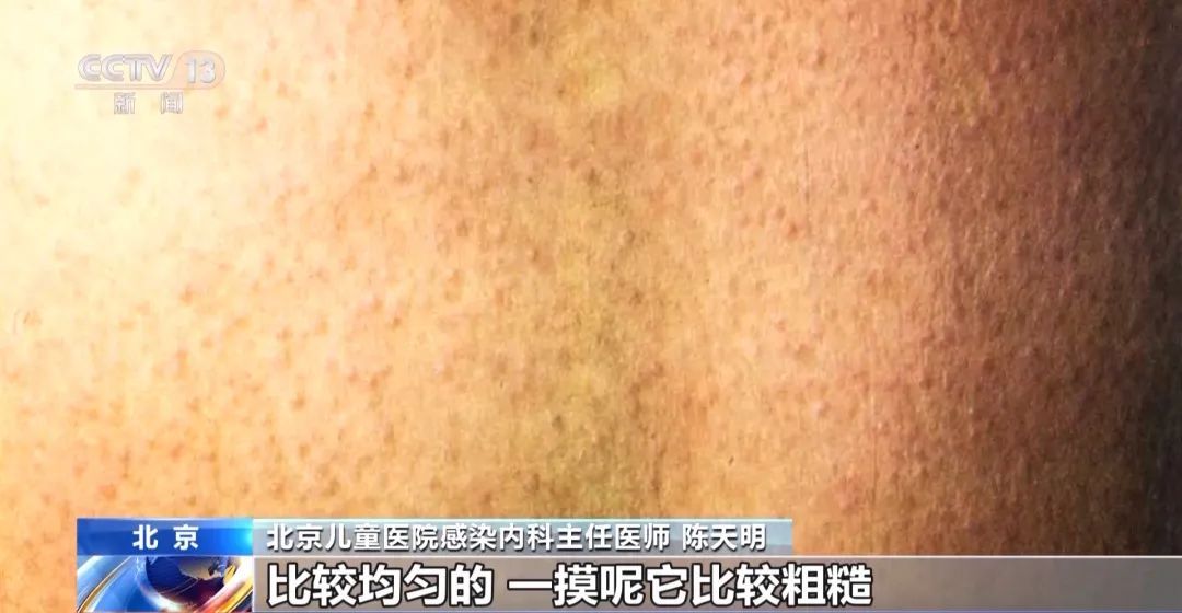 一地确诊1542例！全身皮疹“像鸡皮疙瘩”，尚无疫苗可预防