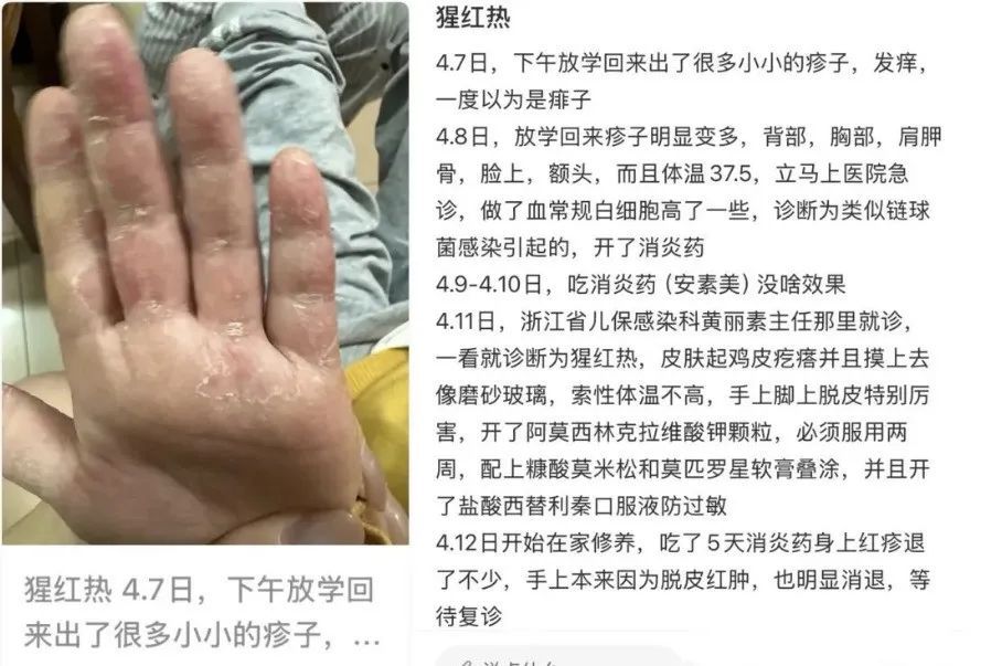 孩子高热不退全身起疹“像鸡皮疙瘩一样”，甚至出现血尿