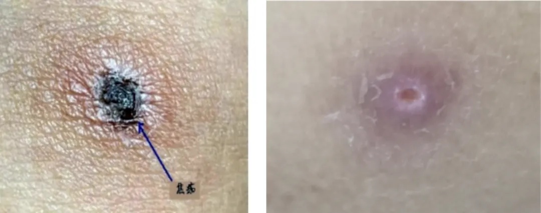 严重可致死！正是高发季，医生紧急提醒