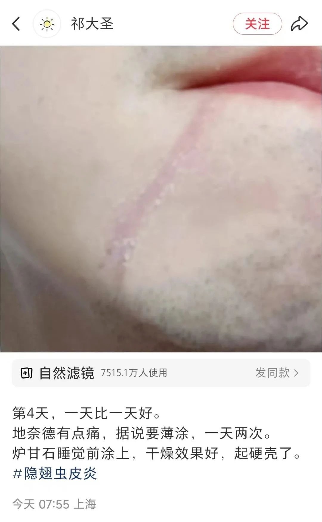 毒液堪比硫酸！又到高发季，一地确诊200多例！紧急提醒：不要拍，有人差点毁容