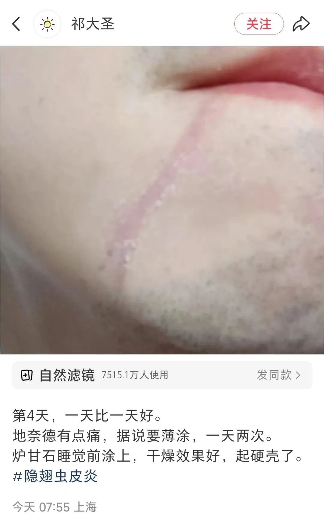毒液堪比硫酸，一地确诊200多例！紧急提醒：不要拍