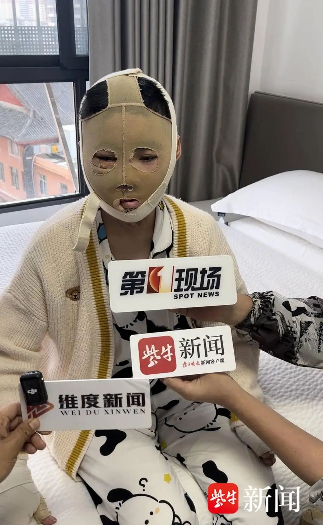 分手后反复纠缠，女孩被前男友泼汽油烧伤致残，男方二审当庭翻供！