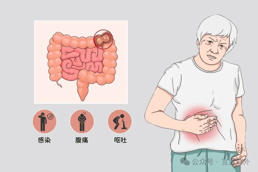 老人谨防食物引起肠梗阻