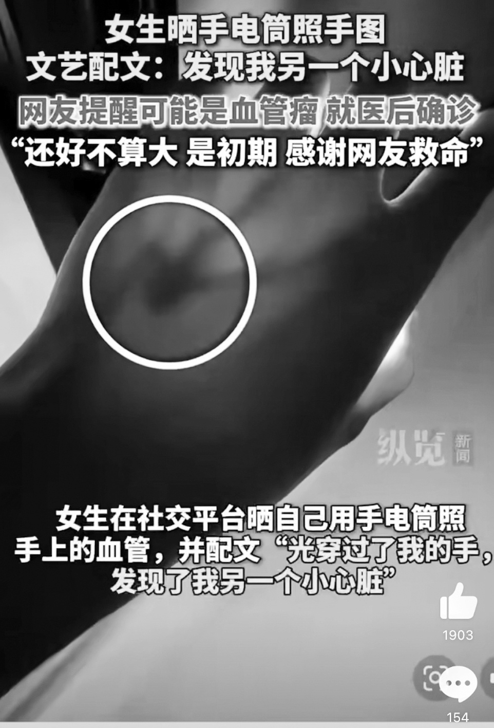 手电筒一照就发现血管瘤 医生：这些危险信号要当心
