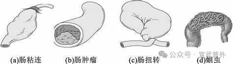 老人谨防食物引起肠梗阻