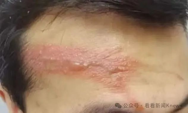 毒液堪比硫酸！ 一地医院已确诊200多例 上海已有人“中招”…医生这样提醒→