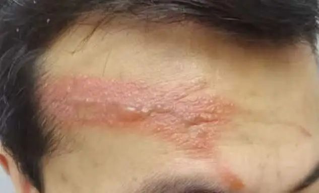 毒液堪比硫酸！一地确诊200多例，有人差点毁容，提醒：不要拍